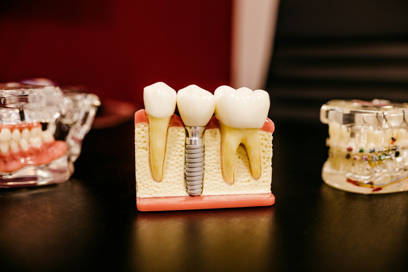 Single tooth dental implant model — Summit Oral Surgery
