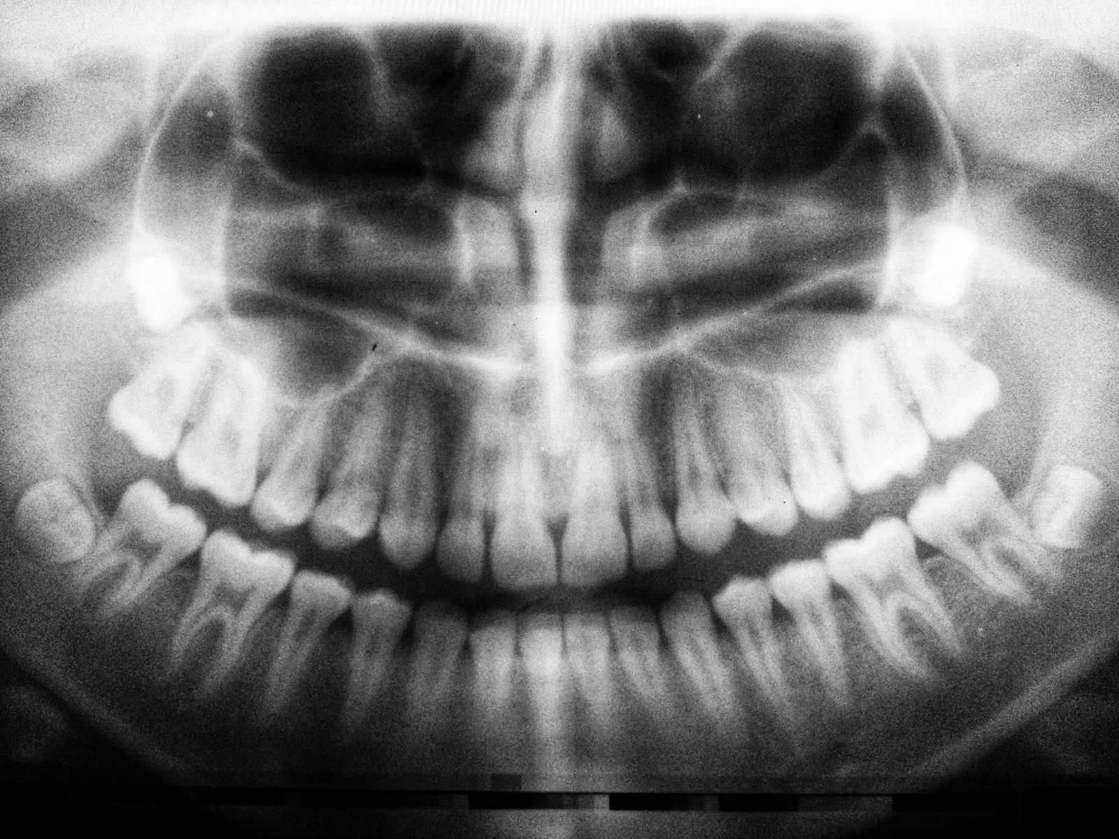 Panoramic dental X-ray showing wisdom teeth — Summit Oral Surgery